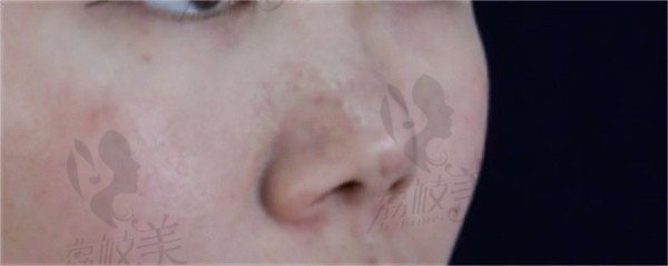 亲历武汉珍妮医美，陈耀文助我实现肋软骨隆鼻美丽逆袭