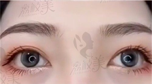 北京张冰洁做真皮卧蚕修复价格4w起,自体真皮组织移植形态更饱满