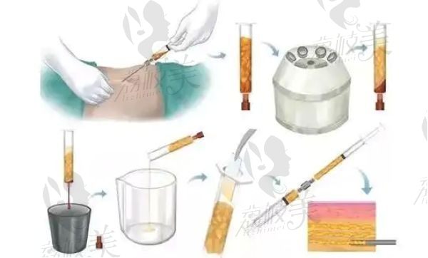 成都艾米丽吸脂案例大公开：腰腹 / 大腿 / 面部真实术后对比图来袭