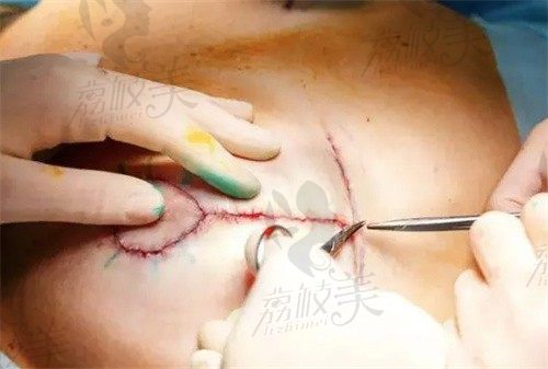 重庆华美陈德法做缩胸手术价格6万起,内窥镜辅助不影响乳腺组织