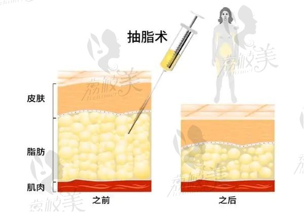 找成都李发展抽脂的人都说了啥？真实患者评价汇总