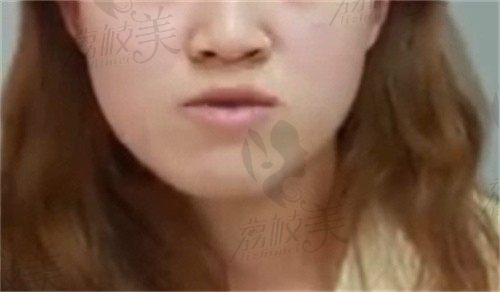 沈阳杏林朱石江做偏颌矫正价格30000起,有效改善面部不对称网友口碑好