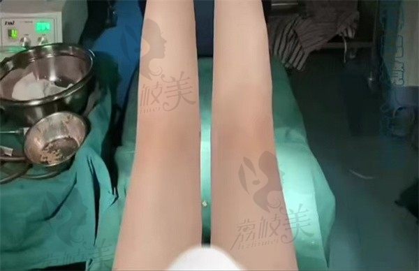 手术后