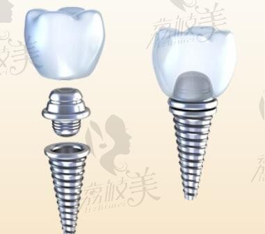 株洲中诺口腔是正规医院吗？种牙没有爆出失败率长期跟踪回访很靠谱