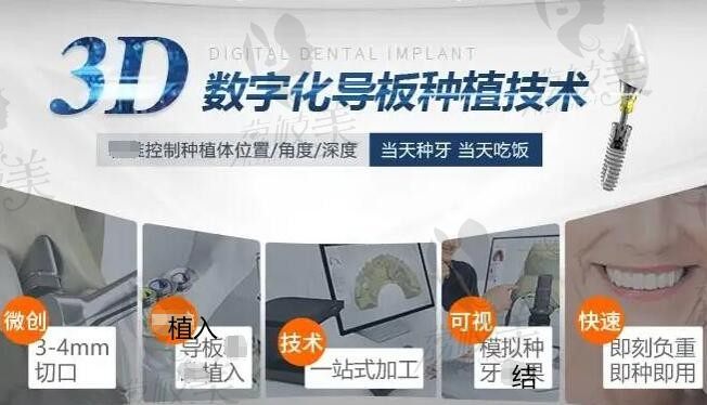 牙元素口腔种植牙技术怎么样？即拔即种 40 分钟完成技术在线价格也不贵