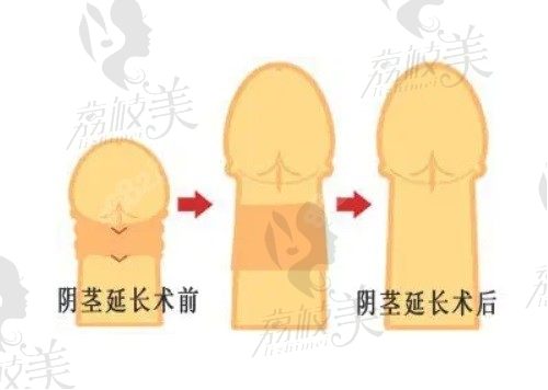 重慶李世榮做陰莖延長(zhǎng)增粗術(shù)很靠譜，李世榮延長(zhǎng)術(shù)真實(shí)范例超多的