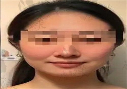 手术后