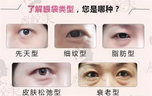 上海張晉寶不開(kāi)刀去眼袋是真的嗎?500+案例中90%患者說(shuō)張晉寶祛眼袋技術(shù)靠譜無(wú)反彈