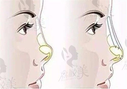 杭州天鑫胡柏做鼻修复手术价格3万起，可有效解决疑难修复问题