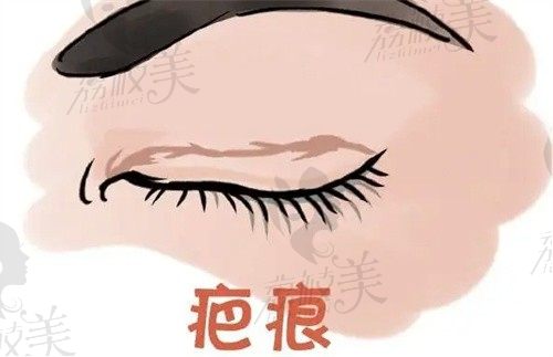 广州丽人黄普利高难度双眼皮修复手术26800起,专研技术可修复多次失败问题