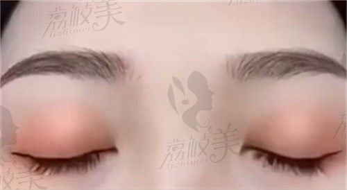 西安柏国芳做双眼皮手术实拍图直出！面诊体验+恢复期图+我的"妈生眼"蜕变实录