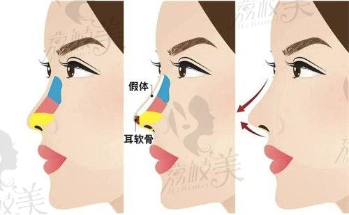 深圳王天国个人资料:从业10余年+做鼻子手术超5000例+患者满意度高+预约攻略速领