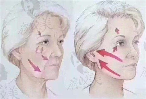 长沙迦美刘志刚做人鱼美雕全面部塑形99800起,疗效好维持时间长