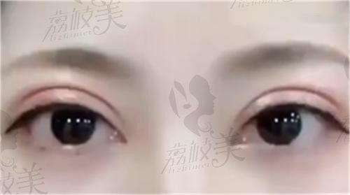三次失败逆袭｜郑州黄军伟修复双眼皮：终于拥有妈生感星星眼