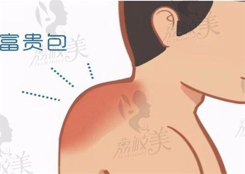 深圳源美朱志祥微创富贵包去除 9800-19800起,专利技术去除干净不反弹