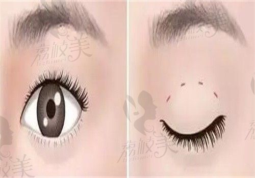 沈阳杏林张莹莹拉双眼皮自然吗？"减张缝合双眼皮"黑科技！闭眼无痕+睫毛自然上翘很自然