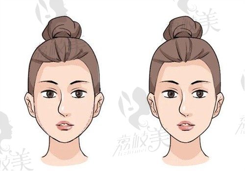 有被杭州整形医生蒋铮铮注射做幼态脸惊到！中面部四层轮廓固定术，4万实现自然抗衰V脸​
