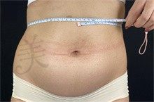 广州张涛吸脂实录：4万=腰腹+大腿组合吸脂，性价比吊打多次小部位抽脂！​