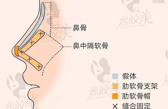 巫文云在哪家医院？都说巫文云做鼻子靠谱是否可信呢2025价格是多少钱