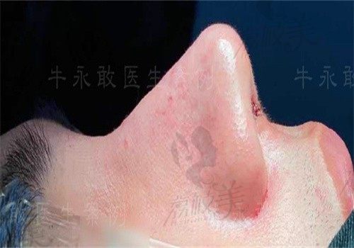 手术后