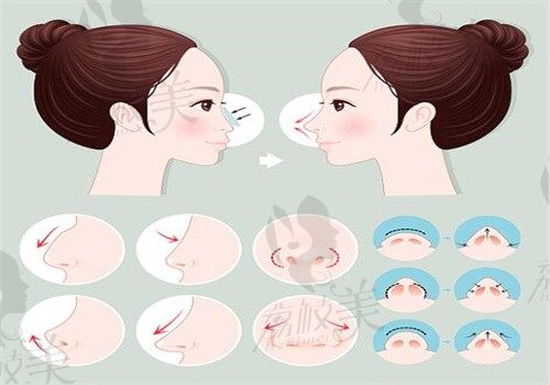 牛永敢鼻修复案例1年追踪：从透光发红到妈生鼻，呼吸顺畅度+90%