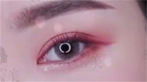 武汉方涛修复双眼皮真实反馈：从‘肿泡眼’到‘妈生款’，术后半年对比图好明显！