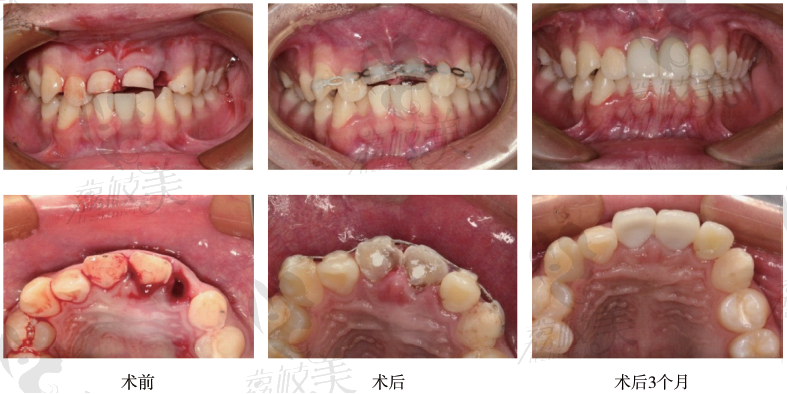 总体牙齿再植