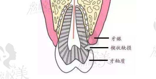 楔状缺损