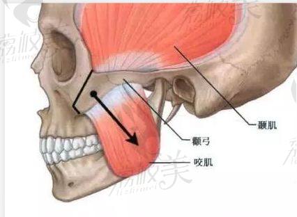 面部轮廓整形手术