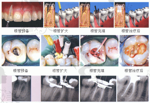 根管治疗后的牙齿