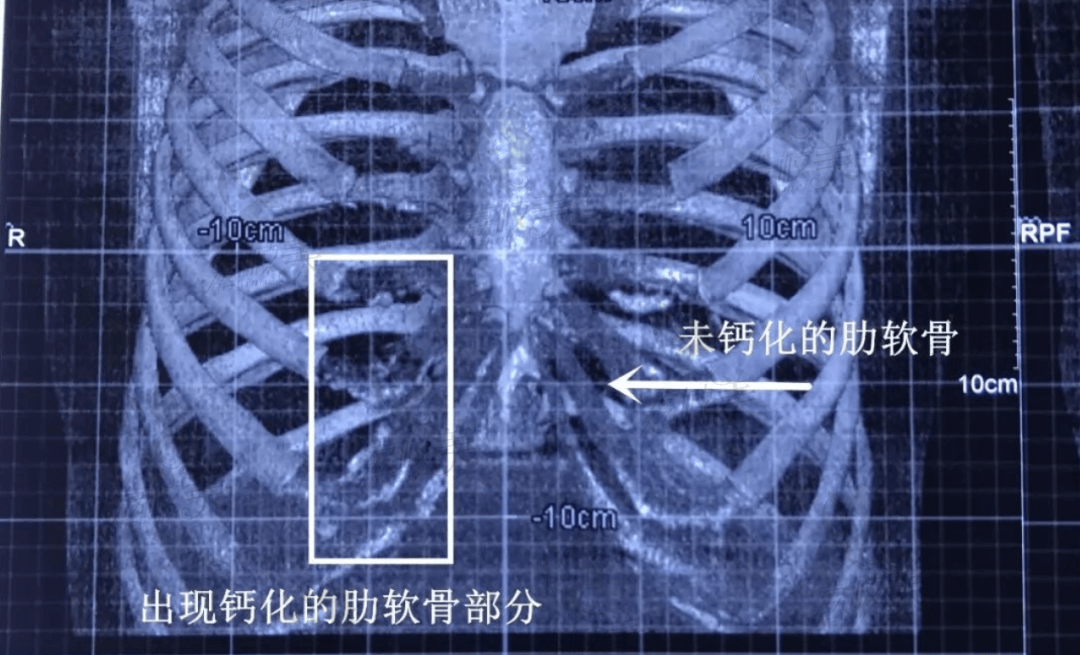 肋软骨钙化