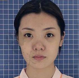 荔枝美：西安艺星医疗美容医院王志BSK鼻综合案例Lisa术前照片