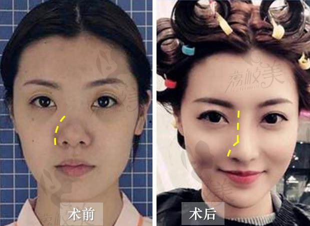 荔枝美：西安艺星医疗美容医院王志BSK鼻综合术前术后对比照