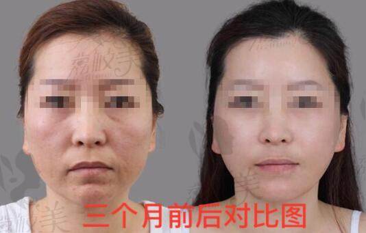 杭州时光医疗美容医院热玛吉案例对比
