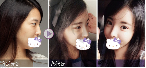 韩国will整形外科鼻部整形第三月