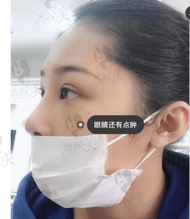 北京美莱隆鼻照片