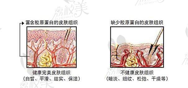 荔枝美 胶原蛋白填充