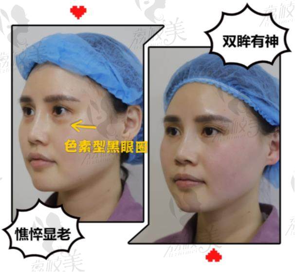 荔枝美：上海时光整形外科医院去黑眼圈案例