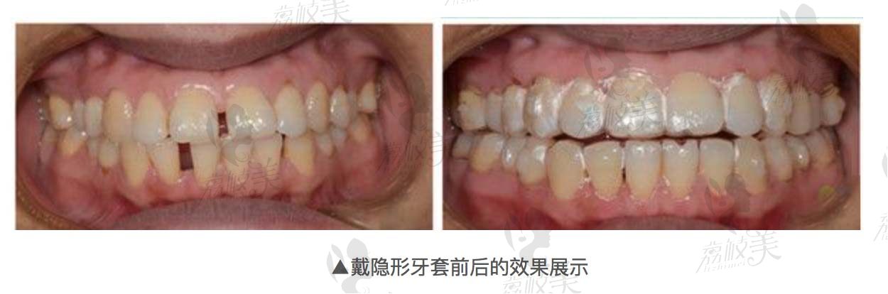 成都博爱口腔矫正案例