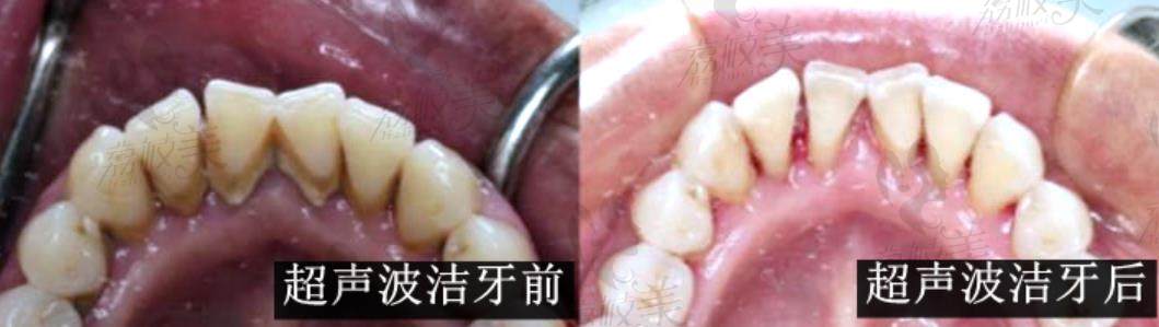 荔枝美：浙江绍兴上虞牙科医院超声波洁牙活动超声波洁牙案例里面