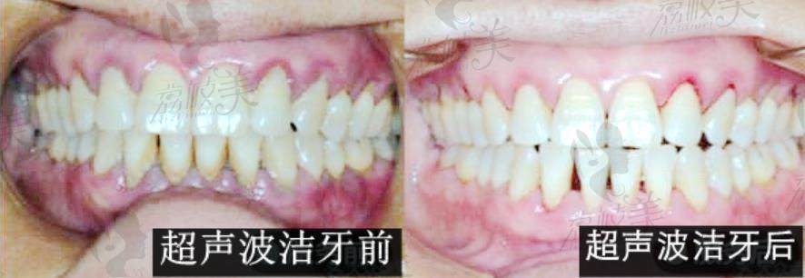 荔枝美：浙江绍兴上虞牙科医院超声波洁牙活动超声波洁牙案例正面