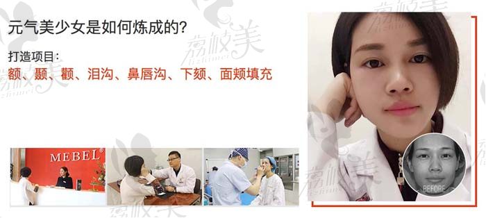 南京美贝尔整形美容医院面部综合案例