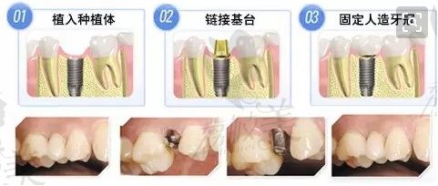 种植牙的过程