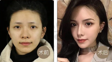 荔枝美 西安艺星美杜莎6D明星眼案例