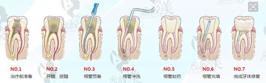 根管治疗五步走