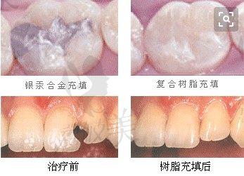 补牙效果图