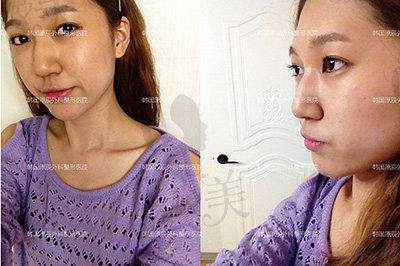 韩国原辰整形外科鼻整形对比
