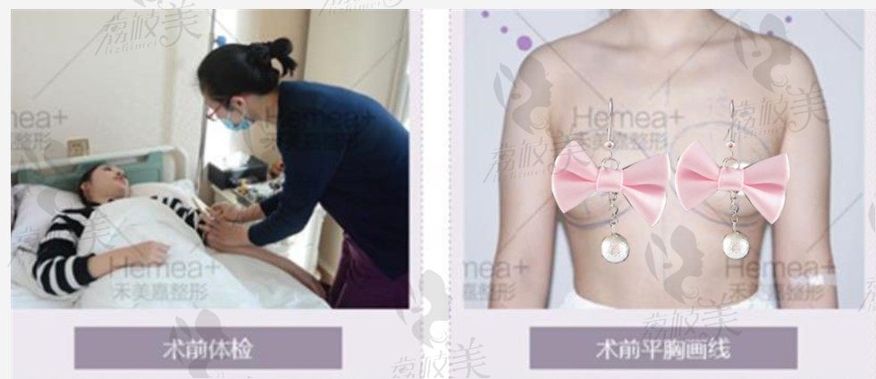 荔枝美：北京禾美嘉美容诊所自体脂肪移植丰胸术前检查