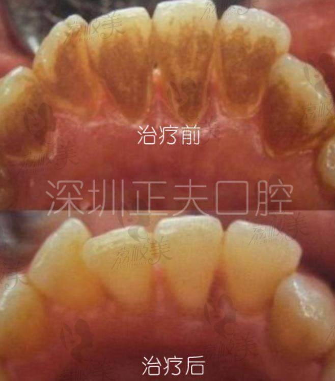 荔枝美：深圳正夫口腔案例洗牙图