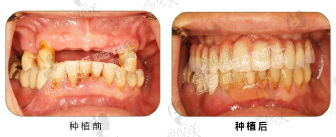 荔枝美：上海雅悦齿科种牙案例